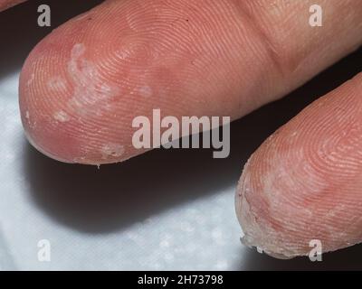 dettaglio dell'esfoliazione dopo la scarlattina in una persona caucasica adulta Foto Stock