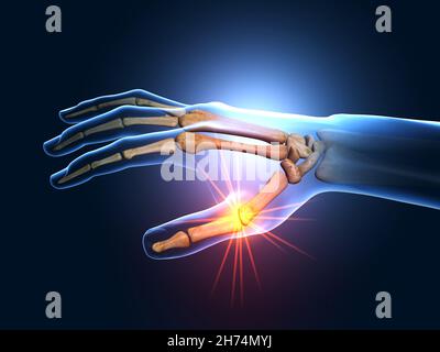 Illustrazione 3D che mostra articolazioni dolorose delle mani Foto Stock