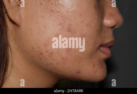 Acne , macchie nere e cicatrici sulla faccia della giovane donna asiatica. Foto Stock