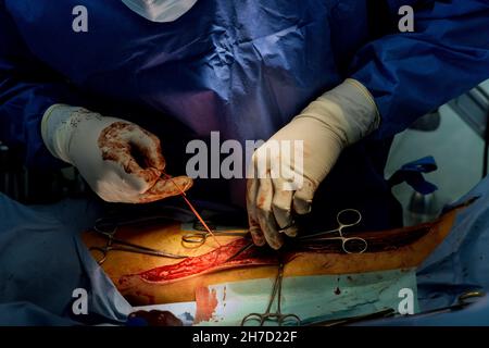 I chirurghi lavorano con la gamba del paziente in sala operatoria Foto Stock