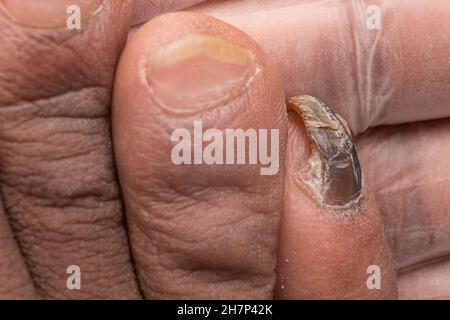 Annerito piccolo toenail distrutto da infezione fungina Foto Stock