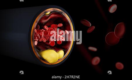 Illustrazione 3d di cellule del sangue con accumulo di placca di colesterolo simbolo di malattia vascolare. Tracciato di ritaglio incluso Foto Stock