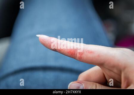 Macro closeup di cerotti rossi sulla pelle indice dito della mano femminile giovane donna mostrando eczema condizione medica chiamato dishidrotic pompholix o vesicu Foto Stock