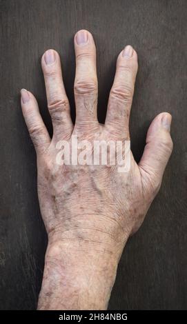 Punti di età sulla mano dell'uomo anziano asiatico. Sono macchie marroni, grigie o nere e anche chiamati macchie di fegato, lentigine senili, lentigine solari, o macchie di sole Foto Stock