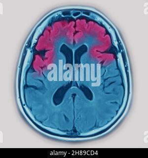 Atrofia cerebrale Foto Stock
