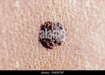 Il melanoma maligno Foto Stock