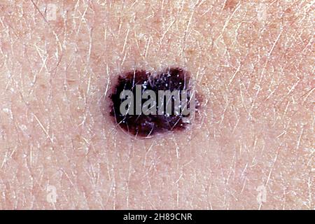 Il melanoma maligno Foto Stock