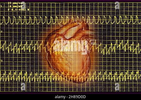 Tachicardia atriale Foto Stock