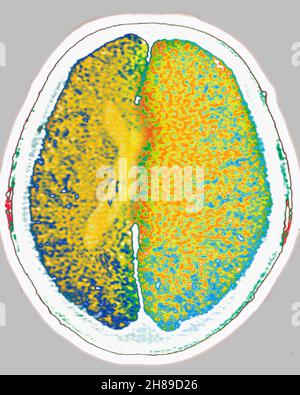 Edema cerebrale Foto Stock