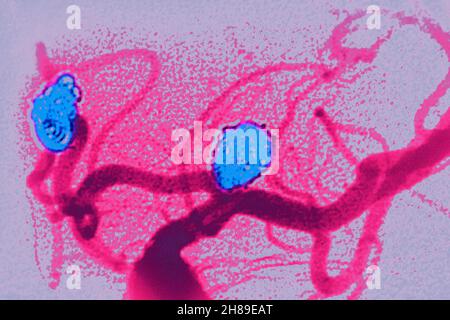 Embolizzazione degli aneurismi cerebrali Foto Stock