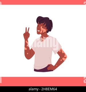 Uomo con vitiligo e depigmentazione della pelle problema, ragazzo divertente mostrando il gesto di vittoria Illustrazione Vettoriale
