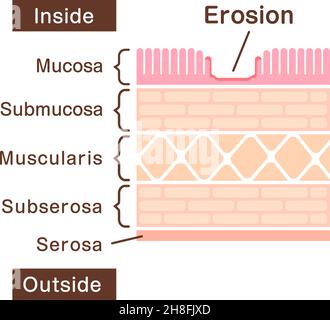 Illustrazione della vista in sezione dell'erosione gastrica Illustrazione Vettoriale