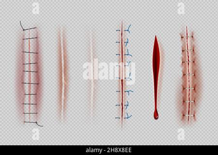 Suture chirurgiche. Punti di primo piano medico cicatrici e ferite decente vettore illustrazioni realistiche Illustrazione Vettoriale