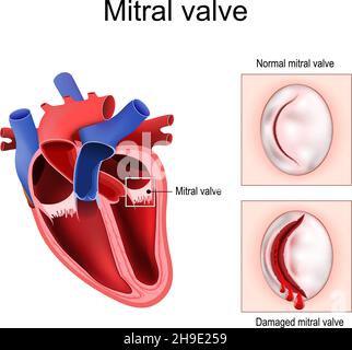 Anatomia cardiaca. Primo piano della valvola mitrale normale e della valvola mitrale danneggiata. Sezione trasversale del cuore umano. Diagramma dettagliato. Poster vettoriale Illustrazione Vettoriale