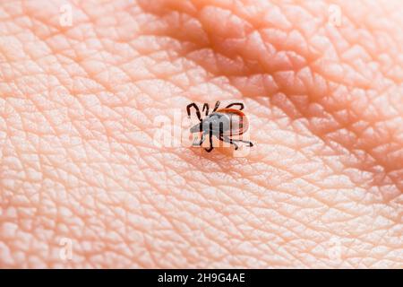 Encefalite infettiva Ixodes Scapularis o Persulcatus Deer Tick Insect sulla pelle. Encefalite virus o malattia di Lyme borreliosi infetta Ixodes Tick Foto Stock