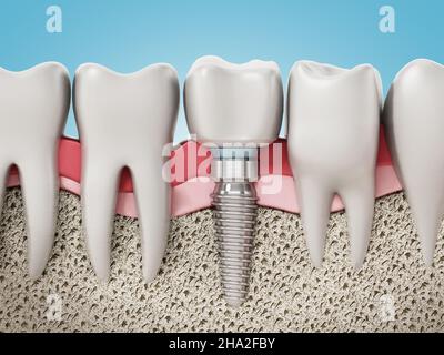 3D rappresentazione di un impianto dentario che mostra la gomma mascellare e gli strati ossei. 3D illustrazione. Foto Stock