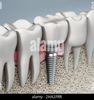 3D rappresentazione di un impianto dentario che mostra la gomma mascellare e gli strati ossei. 3D illustrazione. Foto Stock