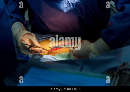 Aprire le ferite delle gambe utilizzando lo strumento durante l'intervento chirurgico Foto Stock