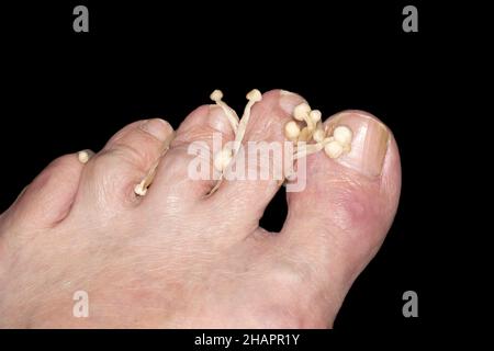 Foto simbolica, Onychomicosis, noto anche come tinea unguium, infezione fungina del chiodo Foto Stock