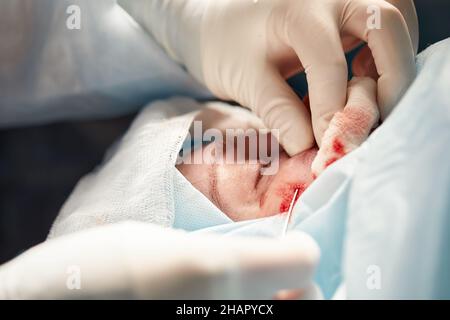 Primo piano del viso di un paziente sottoposto a blefaroplastica. Il chirurgo taglia la palpebra ed esegue manipolazioni con strumenti medici. Foto Stock