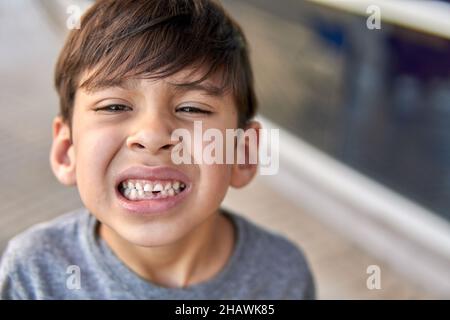 latino toddler cade il suo primo dente e mostra i suoi denti guardando la macchina fotografica in pain.Argentinian. Sfondo sfocato, spazio copia. Foto Stock