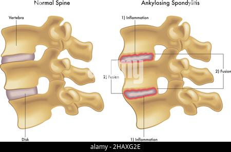L'illustrazione medica confronta una spina dorsale normale con una che mostra i punti che portano alla spondilite anchilosante. Illustrazione Vettoriale