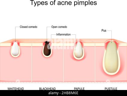 Tipi di pimples dell'acne. Sezione trasversale della pelle umana con vulgaris dell'acne. Diagramma vettoriale Whitehead, Blackhead, papule e pustule. Illustrazione Vettoriale
