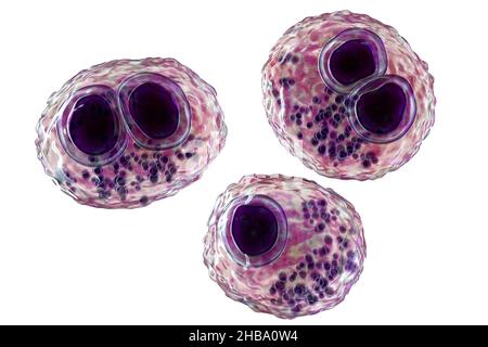 Citomegalovirus umani (HCMV) in una cellula che produce 'occhio del gufo' corpi di inclusione, illustrazione del calcolatore. Le cellule sono multinucleate con vacuolizzazione perinucleare. HCMV è un membro della famiglia degli herpesvirus. Ha un elevato tasso di infezione ed è una delle principali cause di malattia nei neonati vulnerabili e nei pazienti immunocompromessi, ma in genere non causa la malattia negli adulti sani. Foto Stock