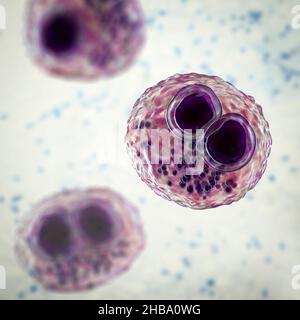 Citomegalovirus umani (HCMV) in una cellula che produce 'occhio del gufo' corpi di inclusione, illustrazione del calcolatore. Le cellule sono multinucleate con vacuolizzazione perinucleare. HCMV è un membro della famiglia degli herpesvirus. Ha un elevato tasso di infezione ed è una delle principali cause di malattia nei neonati vulnerabili e nei pazienti immunocompromessi, ma in genere non causa la malattia negli adulti sani. Foto Stock