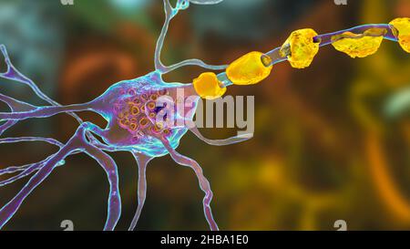 Neuroni nella malattia di Tay-Sachs. Illustrazione che mostra neuroni gonfi con inclusioni lamellari membranee dovute all'accumulo di gangliosidi nei lisosomi. La malattia di Tay-Sachs è un disturbo che distrugge progressivamente i neuroni cerebrali, è causata da una mutazione nel gene HEXA del cromosoma 15 che porta alla deficienza di esosaminidasi A. Tay-sachs è più comunemente osservato nei bambini, manifestandosi nella debolezza muscolare e nella ridotta funzione motoria, perdita della vista e dell'udito, e invalidità intellettuale. Foto Stock