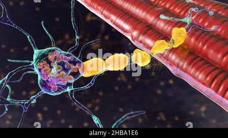 Neuroni nella malattia di Tay-Sachs. Illustrazione che mostra neuroni gonfi con inclusioni lamellari membranee dovute all'accumulo di gangliosidi nei lisosomi, degradazione della mielina. La malattia di Tay-Sachs è un disturbo che distrugge progressivamente i neuroni cerebrali, è causata da una mutazione nel gene HEXA del cromosoma 15 che porta alla deficienza di esosaminidasi A. Tay-sachs è più comunemente osservato nei bambini, manifestandosi nella debolezza muscolare e nella ridotta funzione motoria, perdita della vista e dell'udito, e invalidità intellettuale. Foto Stock