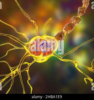 Neuroni nella malattia di Tay-Sachs. Illustrazione che mostra neuroni gonfi con inclusioni lamellari membranee dovute all'accumulo di gangliosidi nei lisosomi. La malattia di Tay-Sachs è un disturbo che distrugge progressivamente i neuroni cerebrali, è causata da una mutazione nel gene HEXA del cromosoma 15 che porta alla deficienza di esosaminidasi A. Tay-sachs è più comunemente osservato nei bambini, manifestandosi nella debolezza muscolare e nella ridotta funzione motoria, perdita della vista e dell'udito, e invalidità intellettuale. Foto Stock