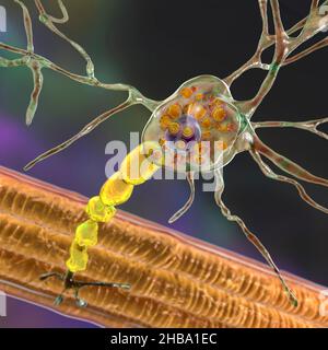Neuroni nella malattia di Tay-Sachs. Illustrazione che mostra neuroni gonfi con inclusioni lamellari membranee dovute all'accumulo di gangliosidi nei lisosomi, degradazione della mielina. La malattia di Tay-Sachs è un disturbo che distrugge progressivamente i neuroni cerebrali, è causata da una mutazione nel gene HEXA del cromosoma 15 che porta alla deficienza di esosaminidasi A. Tay-sachs è più comunemente osservato nei bambini, manifestandosi nella debolezza muscolare e nella ridotta funzione motoria, perdita della vista e dell'udito, e invalidità intellettuale. Foto Stock