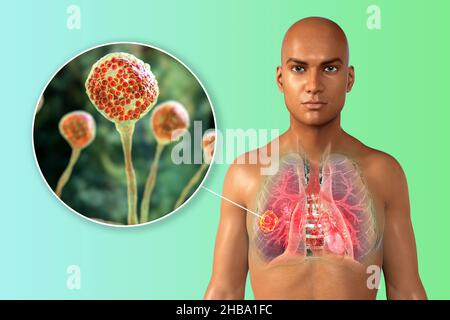 Illustrazione della mucormicosi polmonare (o zigomicosi), una malattia polmonare causata da funghi Mucor sp., noto anche come fungo nero, con una vista ravvicinata di Foto Stock