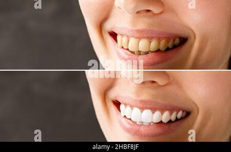 Denti della donna prima e dopo l'imbiancamento. Paziente di clinica dentale. L'immagine simboleggia odontoiatria orale, stomatologia. Foto Stock