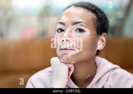 Donna nera afroamericana con pigmentazione vitiligina problema della pelle interna felpa con cappuccio rosa vestita primo piano ritratto pensivo nero pensiero femminile informazioni su Foto Stock