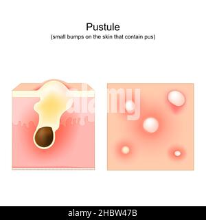 Acne. Pustule è un piccolo urto sulla pelle che contiene pus. Sezione trasversale di una pelle umana. Follicolo per capelli con pus. Vista dall'alto della pelle con i pimples Illustrazione Vettoriale