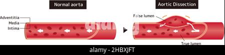 Illustrazione comparativa dell'aorta normale e della dissezione aortica Illustrazione Vettoriale