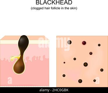 Acne. Testa nera. Poro ostruito. Sezione trasversale di una pelle umana con follicolo dei capelli. Vista dall'alto della pelle con i pimples. Illustrazione vettoriale. Poster Illustrazione Vettoriale