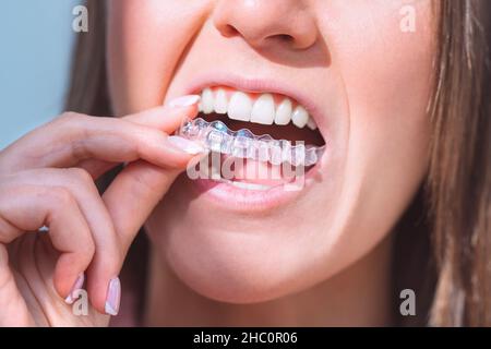 Donna con un sorriso perfetto inserendo allineatori dentali invisibili per la correzione dentale Foto Stock