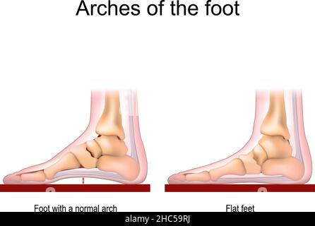 Archi del piede. Piede con arco normale e piedi piatti. Poster vettoriale per uso medico Illustrazione Vettoriale