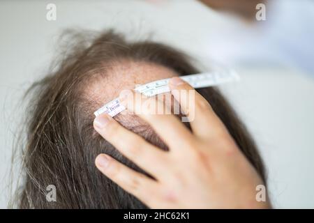 Primo piano delle mani della donna che lavorano per la preparazione del trapianto di capelli sulla testa dell'uomo Foto Stock