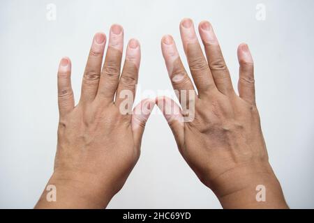 Vista della malattia di Vitiligo su mani isolate su uno sfondo bianco Foto Stock