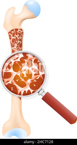 Osteoporosi. Sezione trasversale di un femore. Primo piano della massa ossea e del vetro di ingrandimento. Illustrazione vettoriale Illustrazione Vettoriale