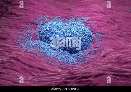 Epatoma cancro del fegato colore blu realistico vista laterale 3D illustrazione Foto Stock