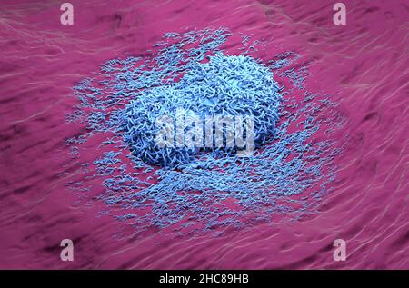 Epatoma del cancro del fegato colore blu realistico vista isometrica 3D illustrazione Foto Stock
