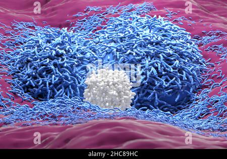 Epatoma del cancro del fegato colore blu con closeup realistico delle cellule T vista 3D illustrazione Foto Stock
