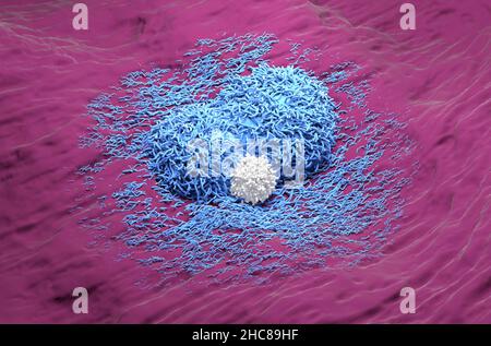 Epatoma del cancro del fegato di colore blu con la vista isometrica realistica delle cellule T 3D illustrazione Foto Stock