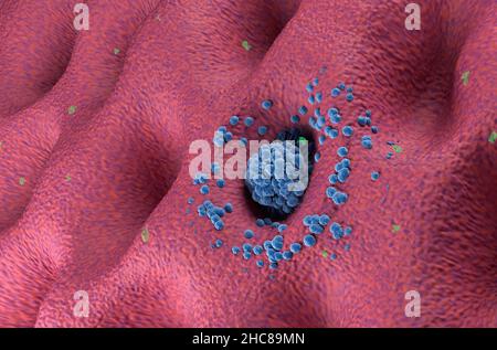 Tumore del cancro gastrico in fase iniziale sull'angolo della parete dello stomaco, illustrazione 3D Foto Stock