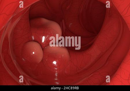 Tumori grandi sulla parete del colon in closeup cancro colorettale vista 3D illustrazione Foto Stock